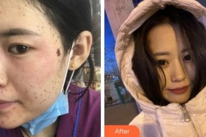 莆田海峽整形美容醫(yī)院傅鳳英整形價(jià)格表附超激光美膚祛斑案例展示