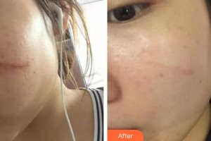 莆田95醫(yī)院整形外科詹新華整形價(jià)格表附祛疤案例展示