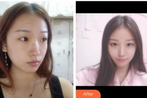 莆田婦產(chǎn)?？漆t(yī)院瑞麗醫(yī)療美容科林必華整形價(jià)格表附手術(shù)縫合祛疤案例展示