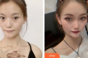 莆田婦產(chǎn)?？漆t(yī)院瑞麗醫(yī)療美容科陳小青整形價(jià)格表附疤痕疙瘩案例展示