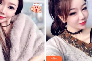 莆田海峽整形美容醫(yī)院胡文華整形價格表附牙齒隱形矯正案例展示