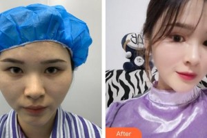 莆田海峽整形美容醫(yī)院魏紫林整形價格表附鼻部手術案例展示