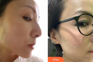 莆田海峽整形美容醫(yī)院陳藝整形價格表附埋線提升案例展示