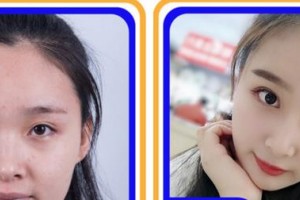 莆田海峽整形美容醫(yī)院申根植整形價格表附鼻部綜合案例展示