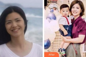 莆田海峽整形美容醫(yī)院朱秀姐整形價格表附牙齒矯正案例展示