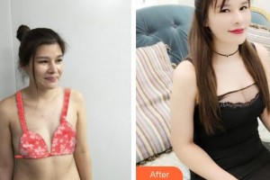 莆田瑞麗整形美容醫(yī)院陳萍住院醫(yī)師整形價格表附自體脂肪隆胸案例展示