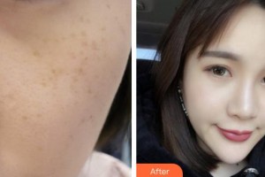 莆田瑞麗整形美容醫(yī)院朱瑛住院醫(yī)師整形價格表附超激光美膚祛斑案例展示