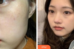 莆田瑞麗整形美容醫(yī)院高明菊住院醫(yī)師整形價格表附蜂巢激光美膚案例展示