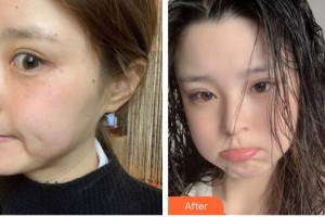 莆田瑞麗整形美容醫(yī)院向瑩住院醫(yī)師整形價格表附激光美膚激光案例展示