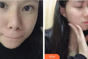 莆田瑞麗整形美容醫(yī)院徐露住院醫(yī)師整形價格表附雙激光美膚案例展示