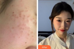 莆田瑞麗整形美容醫(yī)院周萍住院醫(yī)師整形價格表附超激光美膚祛斑案例展示