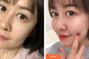 莆田市第一醫(yī)院燒傷整形科黃永新整形價格表附熱瑪吉案例展示