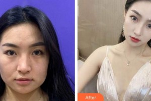 莆田永秀醫(yī)療美容門診部向萌娟整形價格表附熱瑪吉案例展示