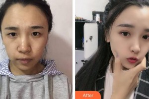 莆田華廈眼科醫(yī)院宋天奇整形價格表附眼部案例展示