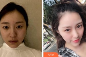 莆田華廈眼科醫(yī)院葉龍玲整形價格表附眼部手術案例展示