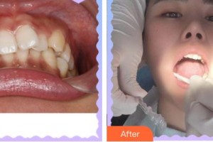 莆田雅美佳口腔醫(yī)院林鳳彬整形價格表附牙齒矯正案例展示