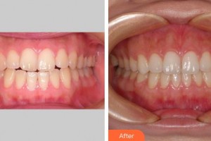 莆田群益口腔門診部黃玉坤整形價(jià)格表附隱形矯正案例展示