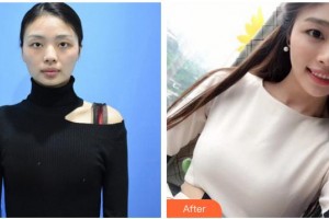 三明市第二醫(yī)院醫(yī)學(xué)美容科陳國(guó)章整形價(jià)格表附自體脂肪隆胸案例展示