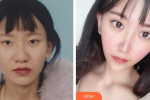 泉州美萊華美整形美容醫(yī)院盧剛整形價(jià)格表附鼻部手術(shù)+切開雙眼皮案例展示