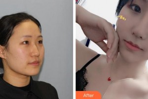 泉州西華醫(yī)療美容醫(yī)院林書燦整形價(jià)格表附肋骨鼻部手術(shù)案例展示