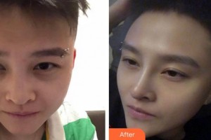 泉州西華醫(yī)療美容醫(yī)院閆保程整形價(jià)格表附鼻部手術(shù)整形案例展示