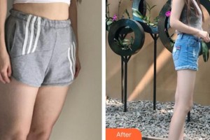 泉州海峽醫(yī)療美容醫(yī)院邵起民整形價(jià)格表附吸脂瘦大腿案例展示