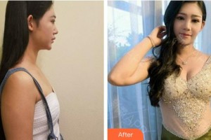 泉州美萊華美整形美容醫(yī)院黃惠銘整形價(jià)格表附自體脂肪豐胸案例展示