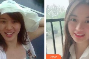 泉州西華醫(yī)療美容醫(yī)院尹慶彬整形價(jià)格表附牙齒矯正案例展示