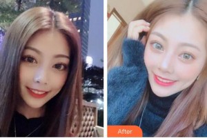 泉州解放軍第180醫(yī)院整形美容中心周劍虹整形價(jià)格表附牙齒美白案例展示