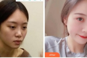 泉州東大整形美容醫(yī)院江昌均整形價(jià)格表附肋軟骨隆鼻案例展示