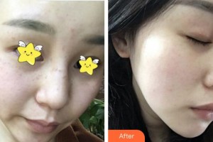 泉州東大整形美容醫(yī)院王雨水整形價(jià)格表附超激光美膚祛斑案例展示