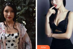 泉州陽光純韓整形醫(yī)院張海帆整形價(jià)格表附假體隆胸案例展示