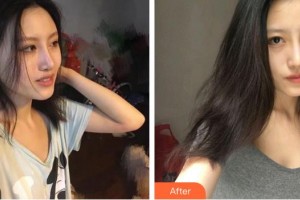 泉州海峽醫(yī)療美容醫(yī)院陳成釗整形價(jià)格表附假體豐胸案例展示