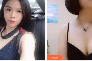 泉州市婦幼保健院整形外科林文雄整形價(jià)格表附假體隆胸案例展示