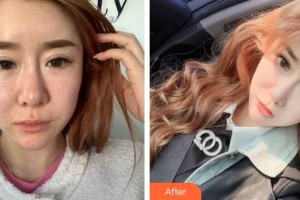 泉州黃氏整形醫(yī)院盧麗華整形價(jià)格表附年輕化埋線提升案例展示