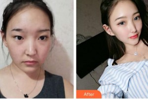 泉州黃氏整形醫(yī)院黃紹華整形價(jià)格表附埋線提升案例展示