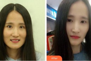 泉州歐菲醫(yī)療美容門診部王忠政整形價(jià)格表附瓷貼面案例展示