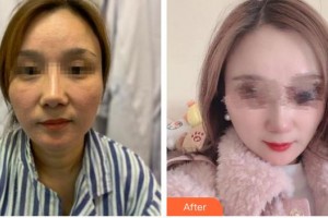 泉州歐菲醫(yī)療美容門診部姚果整形價(jià)格表附埋線提升日記案例展示