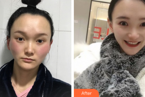 廣州麗尚整形美容門診部吳昌鉉整形價(jià)格表附顴骨顴弓案例展示