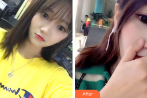 廣州美恩整形美容醫(yī)院鐘苑均整形價格表附超聲波潔牙案例展示