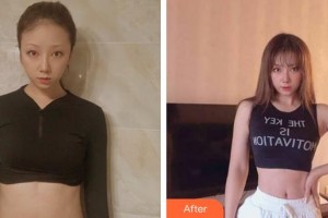 泉州美萊華美整形美容醫(yī)院張旭華整形價(jià)格表附疤痕案例展示