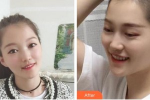 泉州西華醫(yī)療美容醫(yī)院湯麗華整形價格表附金屬托槽矯正案例展示