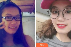 泉州西華醫(yī)療美容醫(yī)院陳莉芳住院醫(yī)師整形價格表附牙齒矯正案例展示