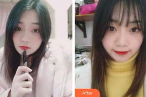 泉州西華醫(yī)療美容醫(yī)院盛瓊花整形價格表附牙齒隱形矯正案例展示