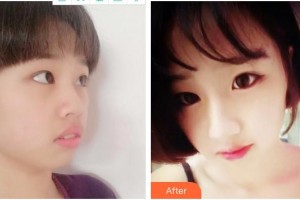 泉州億星醫(yī)療美容門診部秦念國整形價格表附隆鼻案例展示