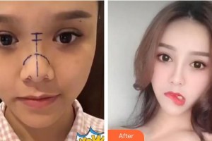 泉州億星醫(yī)療美容門診部李波整形價格表附隆鼻案例展示