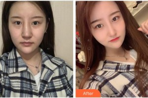 泉州億星醫(yī)療美容門診部李家廣整形價格表附半肋鼻部手術案例展示