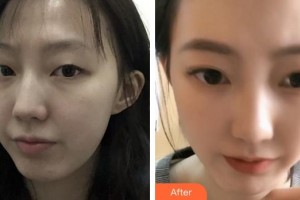 泉州億星醫(yī)療美容門診部張翼飛整形價格表附眼部綜合案例展示