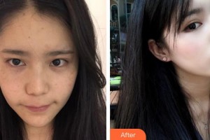 泉州海峽醫(yī)療美容醫(yī)院何春整形價格表附超激光美膚案例展示