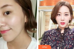 泉州歐菲醫(yī)療美容門診部鄧龍威整形價格表附超激光美膚案例展示